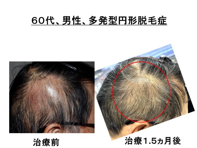 円形脱毛症　病院